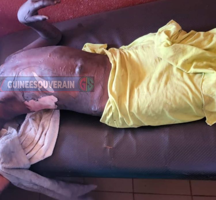 Mandiana : une fillette brûlée au troisième degré par sa marâtre